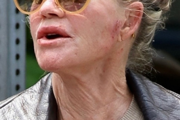 Ožiljci, kraste i modrice: Lice jedne od najfatalnijih žena Holivuda doslovno se raspada, zastrašujuće fotografije