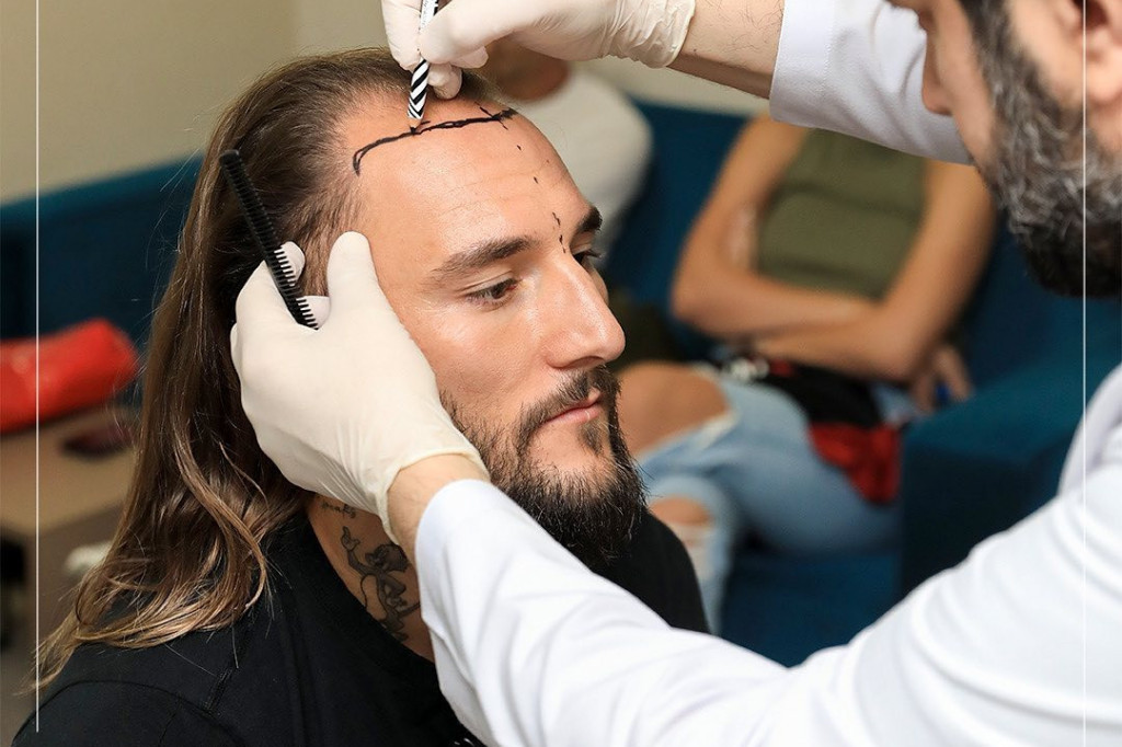 Nemanja Gudelj pokazao kako izgleda posle presađivanje kose: Sad liči na poznatog pevača, nećete verovati svojim očima FOTO